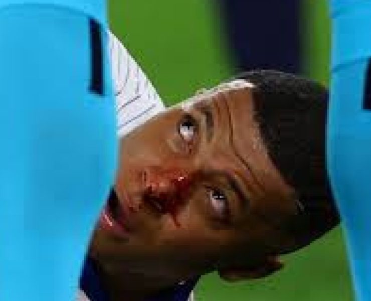 El refuerzo bomba del Real Madrid Kylian Mbappé, sufrió una escalofriante lesión, durante el primer partido de Francia, en la Eurocopa 2024.