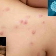 Cuatro estados de la república mexicana, han reportado casos de la Viruela del Mono también conocida como Mpox.