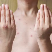 Casos varicela en Tabasco superan expectativas