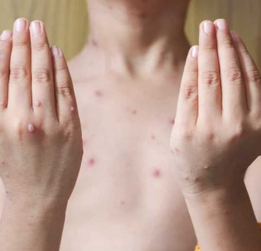 Casos varicela en Tabasco superan expectativas
