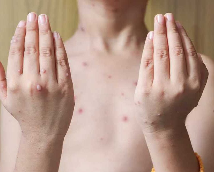 Casos varicela en Tabasco superan expectativas