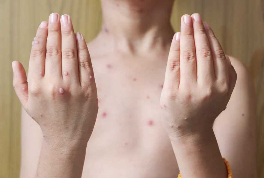 Casos varicela en Tabasco superan expectativas