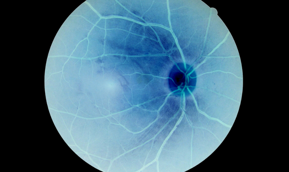 ¿Qué es la retinitis y por qué se produce?
