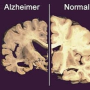 Nuevo tratamiento contra perdida de memoria demuestra grandes avances