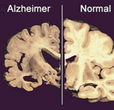 Nuevo tratamiento contra perdida de memoria demuestra grandes avances