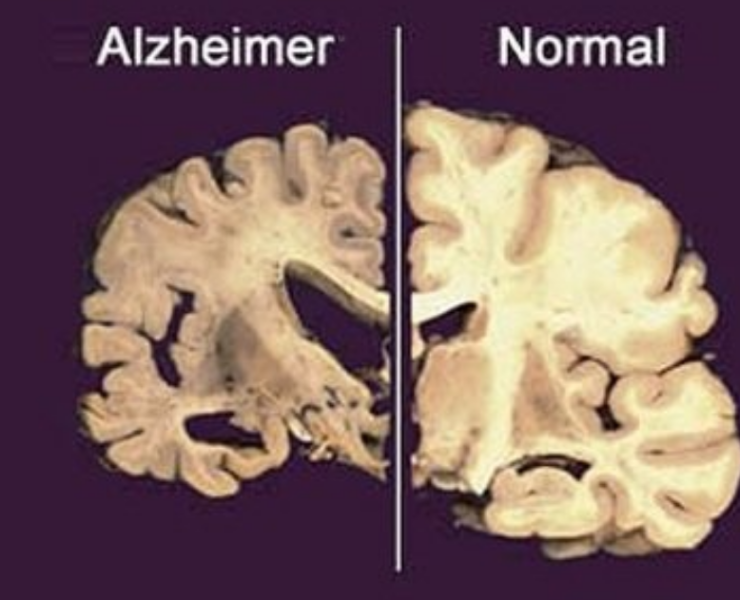 Nuevo tratamiento contra perdida de memoria demuestra grandes avances