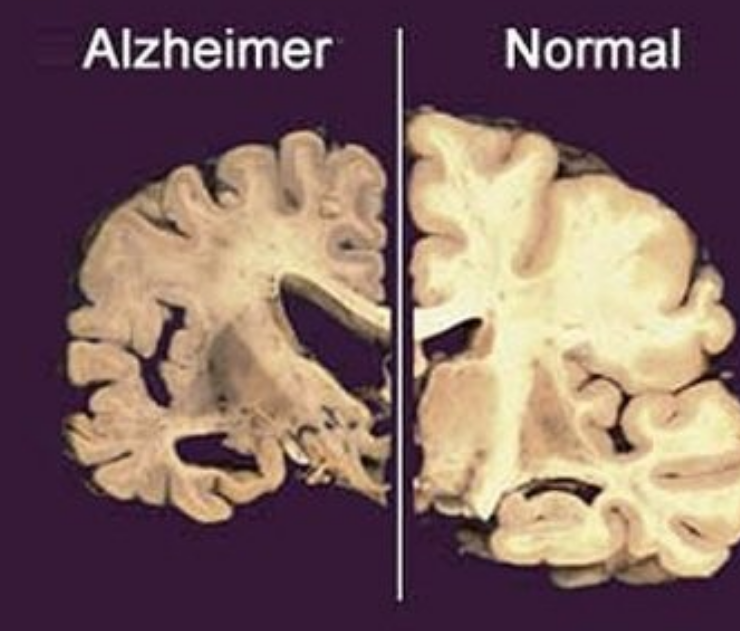 Nuevo tratamiento contra perdida de memoria demuestra grandes avances