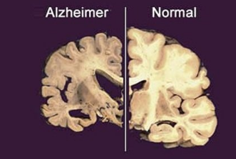 Nuevo tratamiento contra perdida de memoria demuestra grandes avances