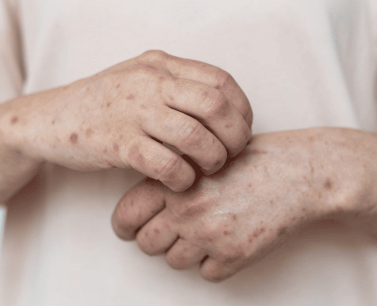 Detectan nuevos casos de sarampión en Tabasco